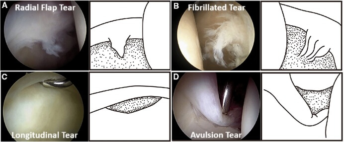 Types of Hip Labrum Tear: Radial Flap Tear, Radial Fibrillated Tear, Longitudinal Tear and Unstable Avulsion Tear. Copyright Researchgate