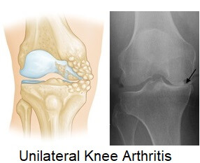(Left) Osteoarthritis that is limited to the medial compartment. (Right) This x-ray shows severe osteoarthritis with "bone-on-bone" degeneration in the medial compartment (arrow).