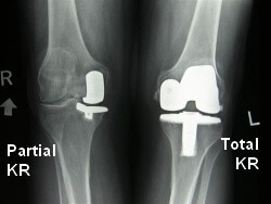 Partial knee replacement vs Total knee replacement