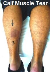 Common Knee Injuries: Causes & Treatment - Knee Pain Explained