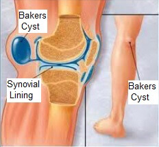 pain behind the knee diagnosis treatment knee pain explained