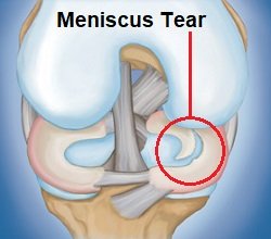 Understand Knee Joint Anatomy - Knee Pain Explained