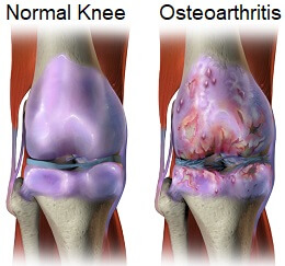 Medial Knee Pain - Common Causes of Inner Knee Pain